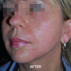 Microneedling Liverpool